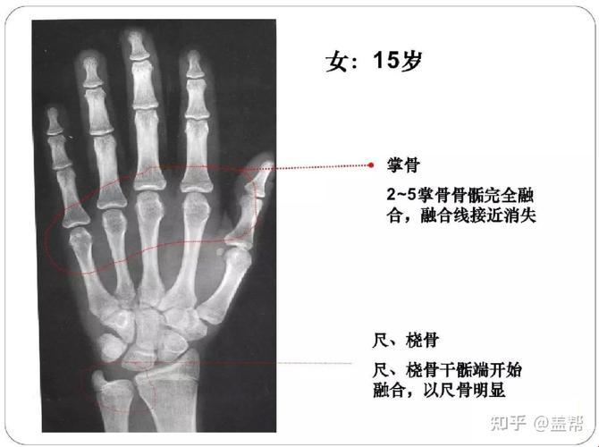 骨龄测试，身高的“终极预言”？