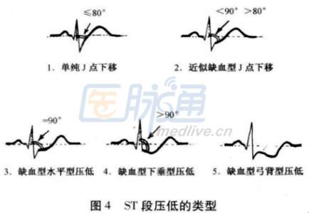 年轻人的T波小剧场：自愈与否，谁说了算？