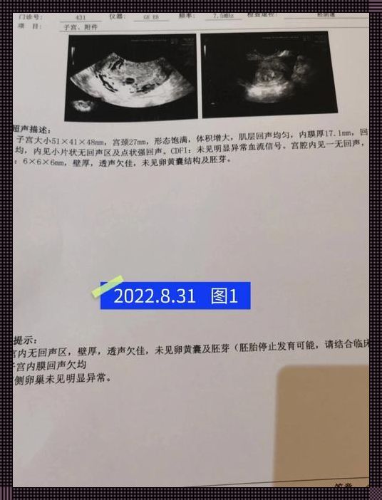 “囊芽差小会胎停吗？”——笑谈孕育的奇妙误会