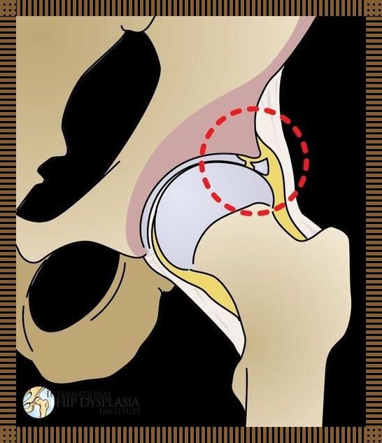 髋臼唇探秘：人体地图上的隐藏宝藏