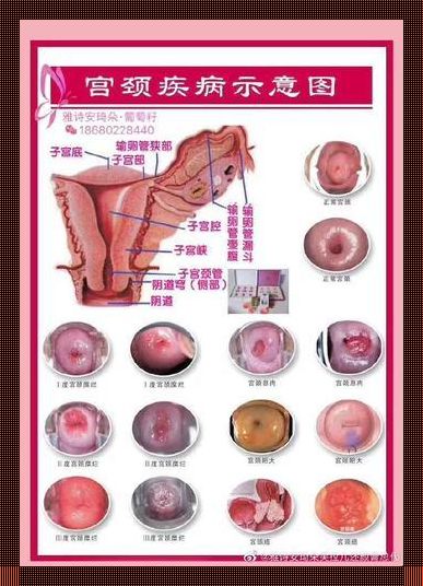 宫颈糜烂，我给自己疼点颜色瞧瞧