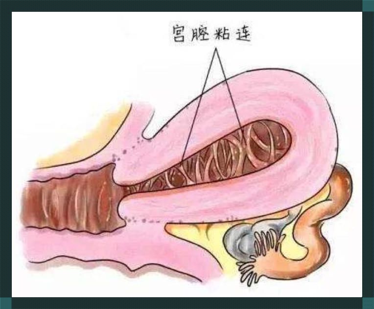 宫腔粘连，怀上孩子的“奇幻之旅”