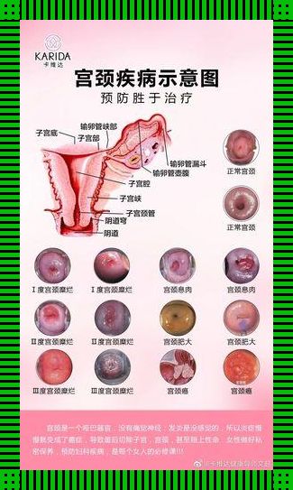 宫颈糜烂的自白：笑谈苦难，谁解其中味？