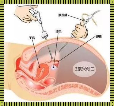 “宫外孕”手术，一场误解引发的幽默狂想曲