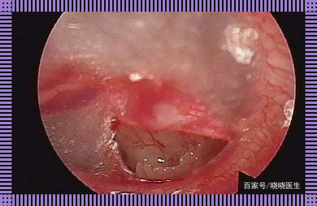 右侧鼓膜穿孔，幽默看人生：“耳”界大战硝烟起