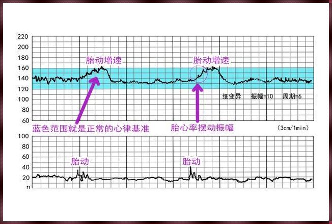 《胎心监护图谱，揭秘“宫缩”的诡秘脸谱》