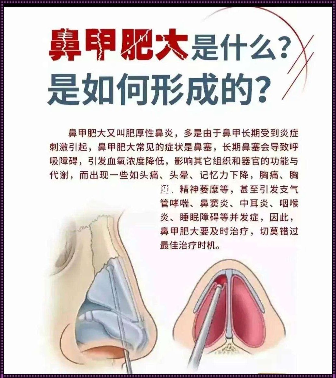 鼻孔堵塞，人生停摆：鼻甲肥大的症状及危害