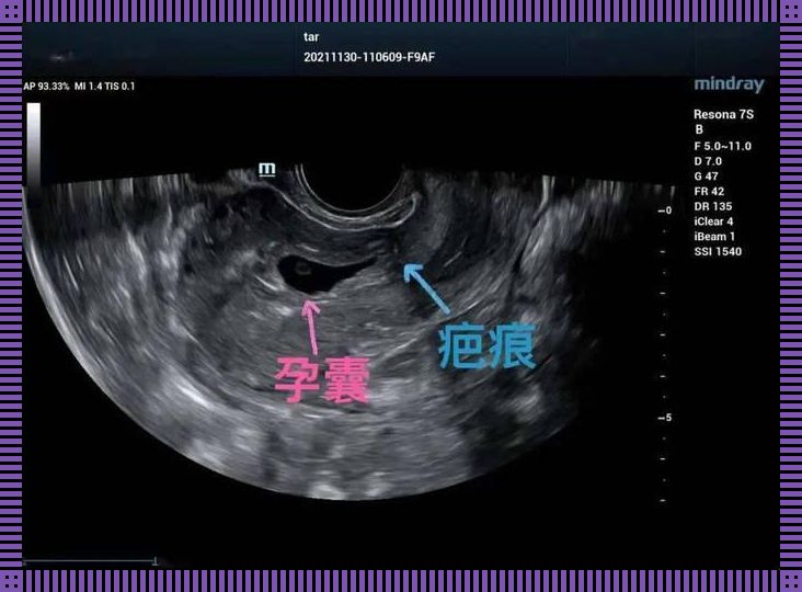 超级难题：B超，破解疤痕妊娠的迷局