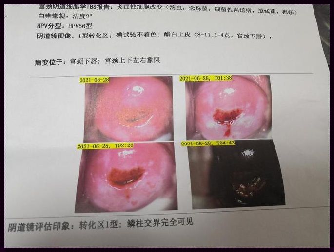 低度病变，三个月药效能否逆天改命？