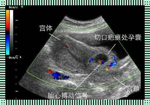 瘢痕妊娠流产手术，险象环生还是小菜一碟？