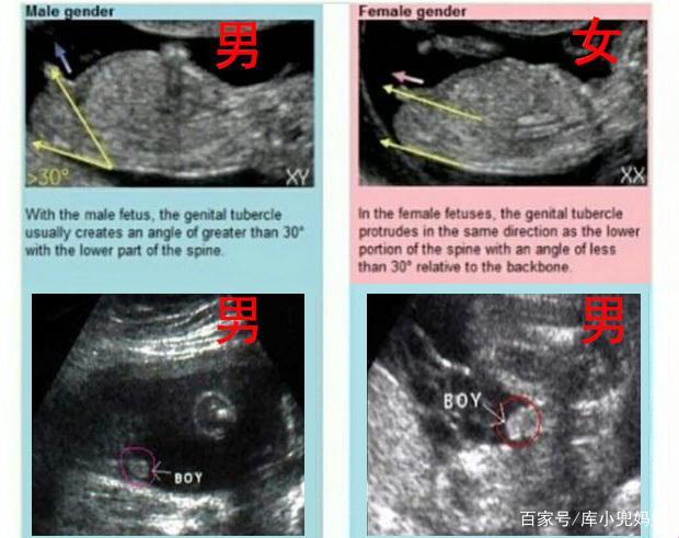 彩超神探: 瞄准小弟弟还是小妹妹？