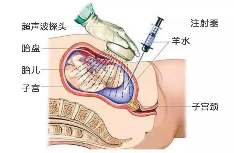 “养水穿刺”检查啥？笑谈奇闻怪事！