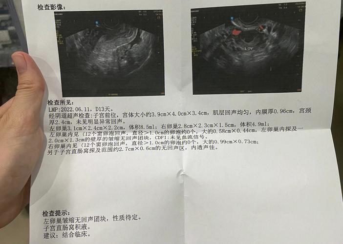 子宫直肠窝积液挂号记：笑出腹肌的科室奇遇