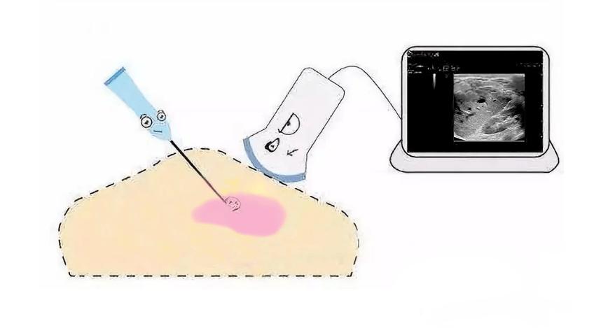 经阴超和B超，搞不懂？来，哥给你露一手！