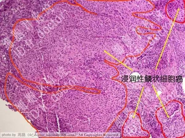 “微侵”宫颈，笑谈鳞癌：揭秘“微小浸润性鳞状细胞癌”