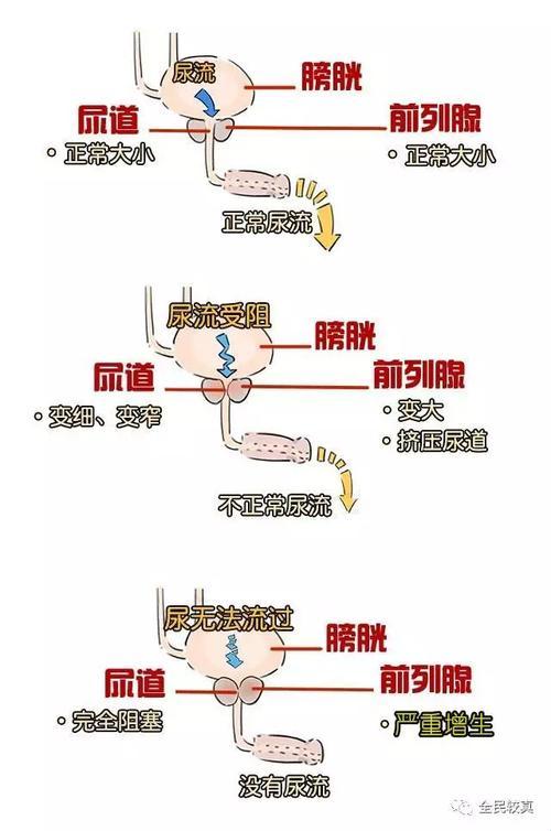 前列腺体积大，揭秘“巨无霸”的奥秘