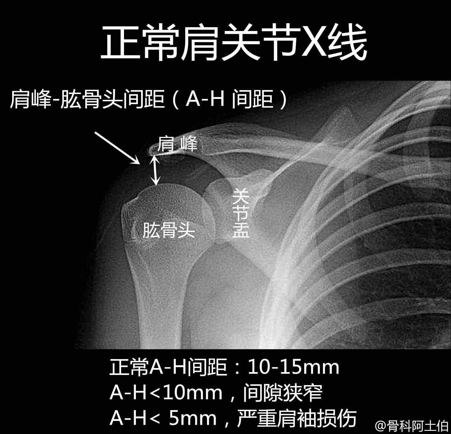 肩关节解剖图“炫”技：X光下的惊悚剧场