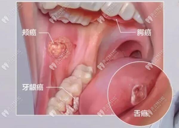 “牙龈萎缩”，哦，癌症的前兆？笑谈！