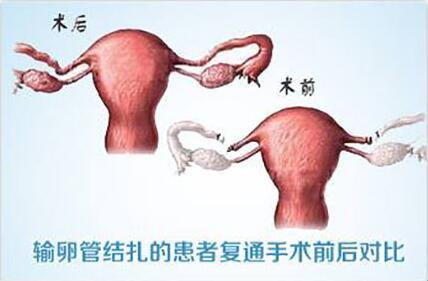 绝育再通，幽默还是苦涩？