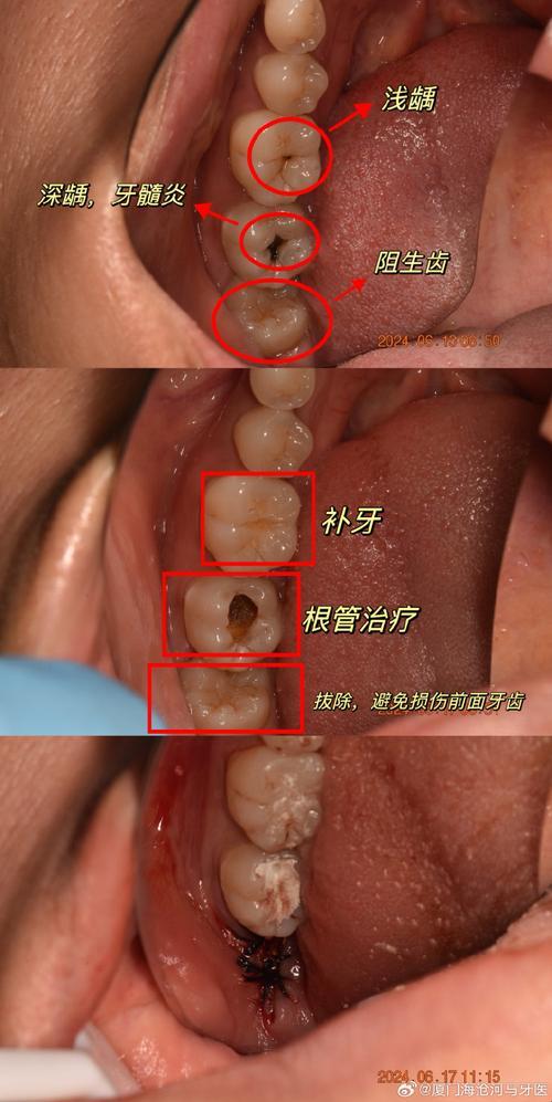 脱落计时：根管后的牙齿，离自由还有几光年？