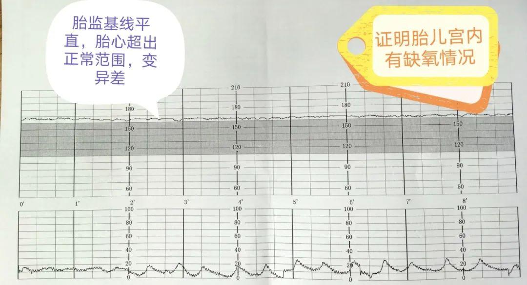 胎心监护那些神叨叨的T和M，你猜是啥意思？