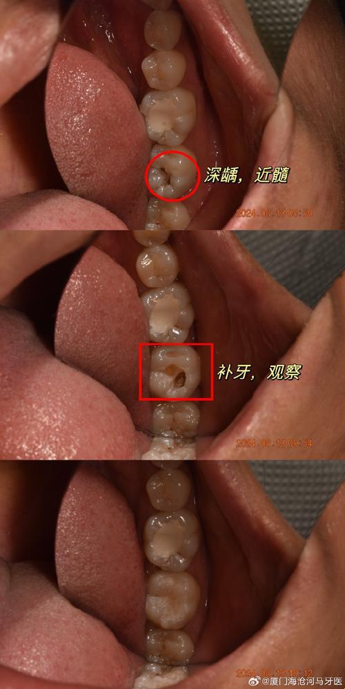 门牙小洞，不补之谜：笑谈牙科“潜规则”