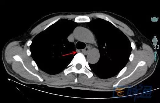 肺部CT，食道也来“抢戏”？