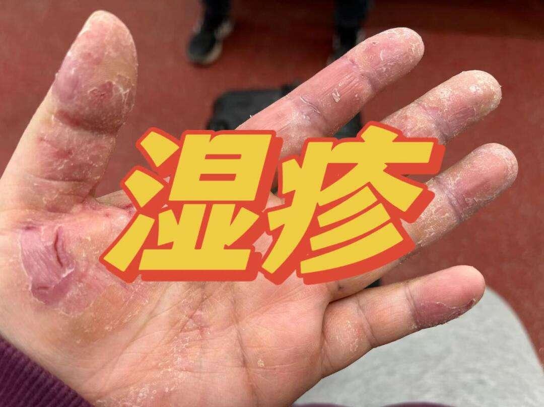 湿疹，哪个脏腑的“捣蛋鬼”在作祟？