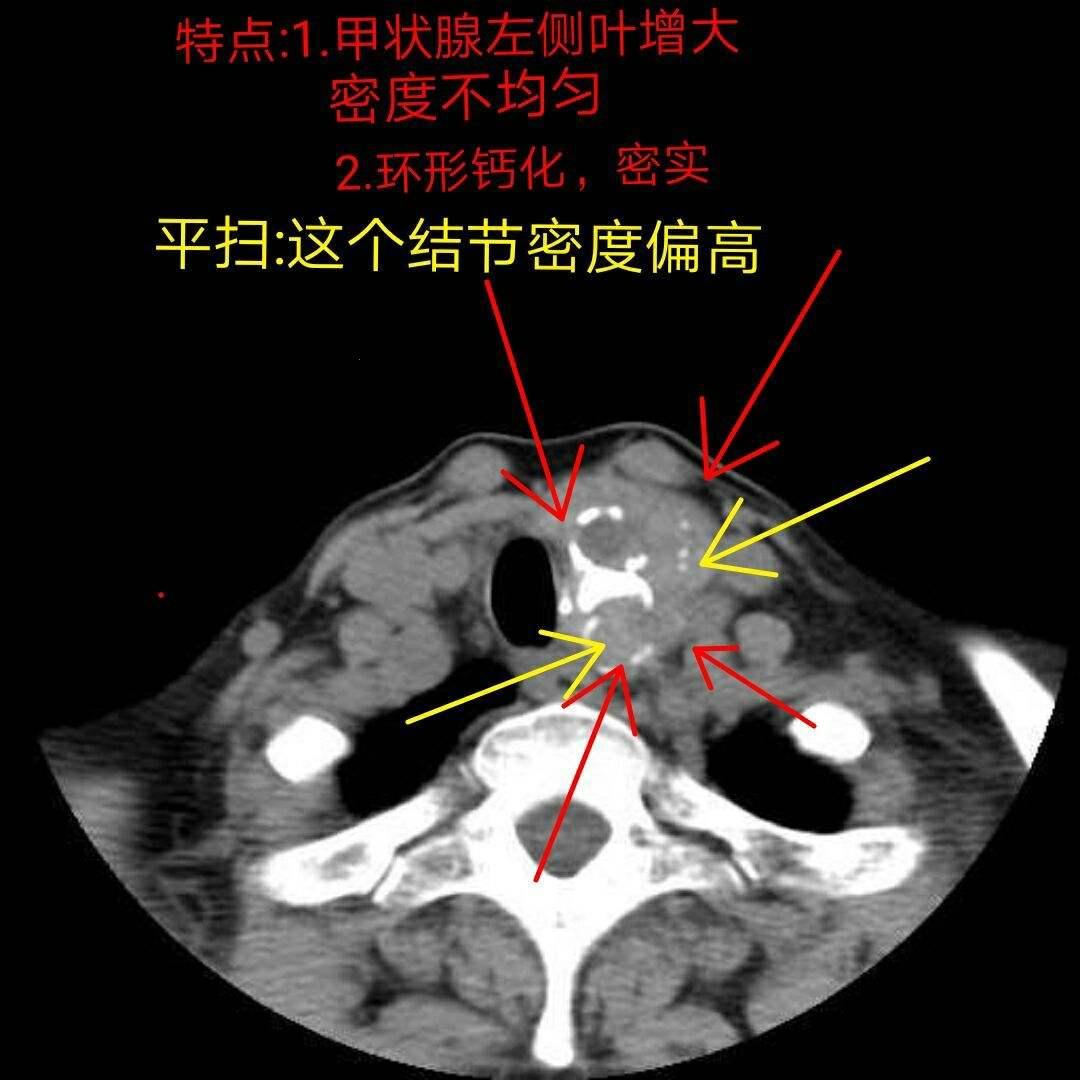 甲状腺结节，恶魔的诱惑？