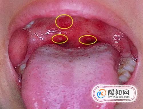 肚子里有虫子？笑话，症状千奇百怪！