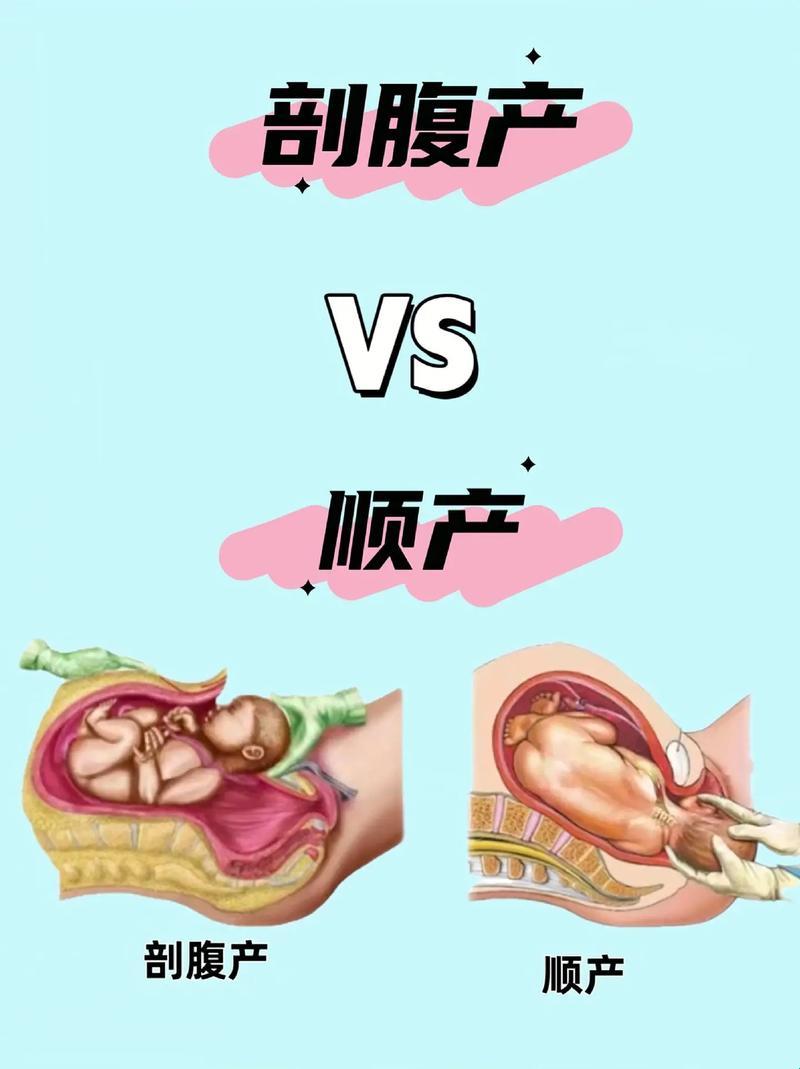 顺产与剖腹：江湖对决，谁主安全？