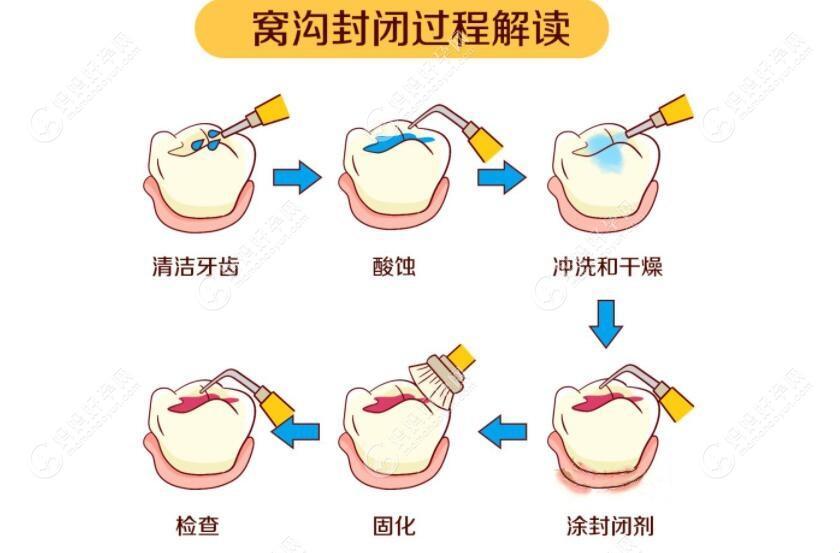 “窝沟封闭”奇遇记：图解辣眼睛的牙科探险