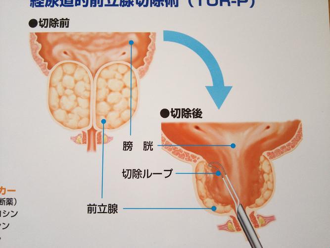 前列腺膨胀记：size up，手术否？