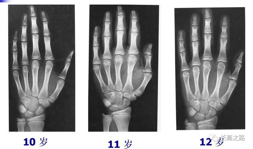 X光透视下，骨龄的秘密笑谈间！