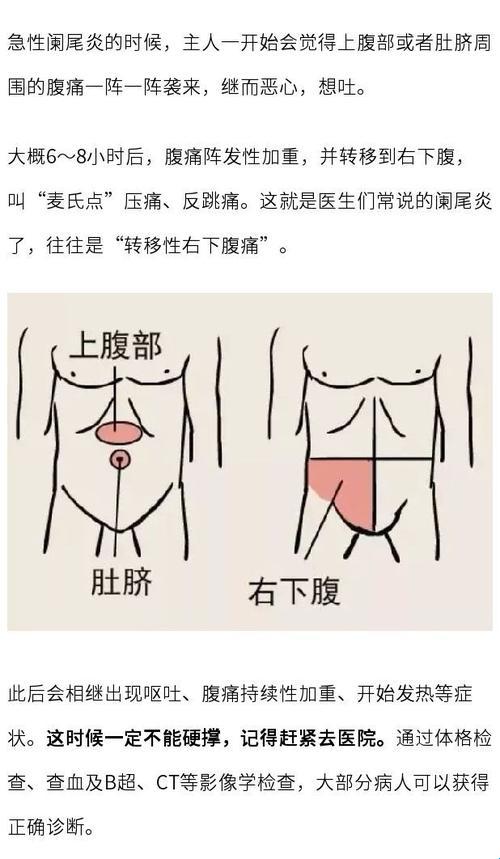 女生的阑尾炎疼痛位置图鉴：趣味解读！