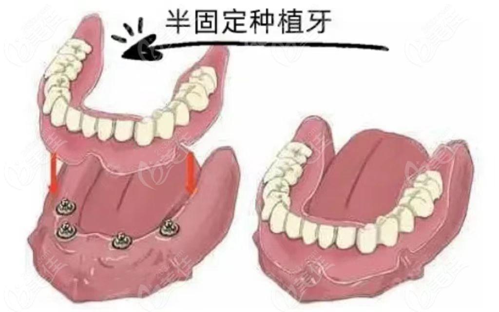 齿间岁月，种牙界的“高龄禁忌”是个啥玩意儿？