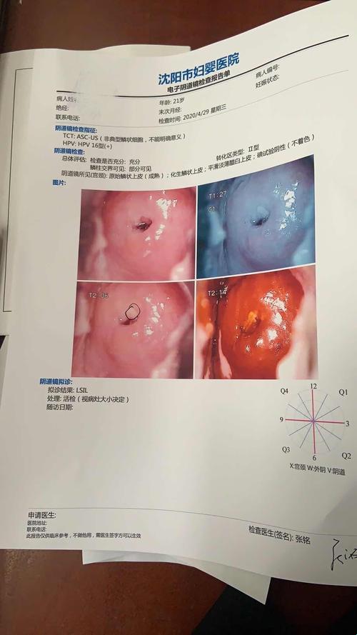 宫颈活检四大胜地，病变旅游团的奇遇