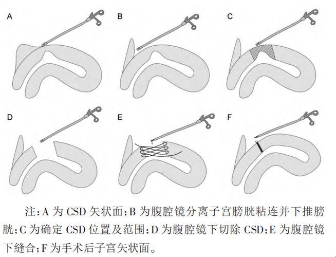 肚子里的秘密：剖腹产后二十天，子宫大小的奇妙比喻