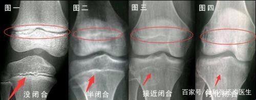 骨骺线闭合，增高梦碎？笑谈中揭露真实案例！