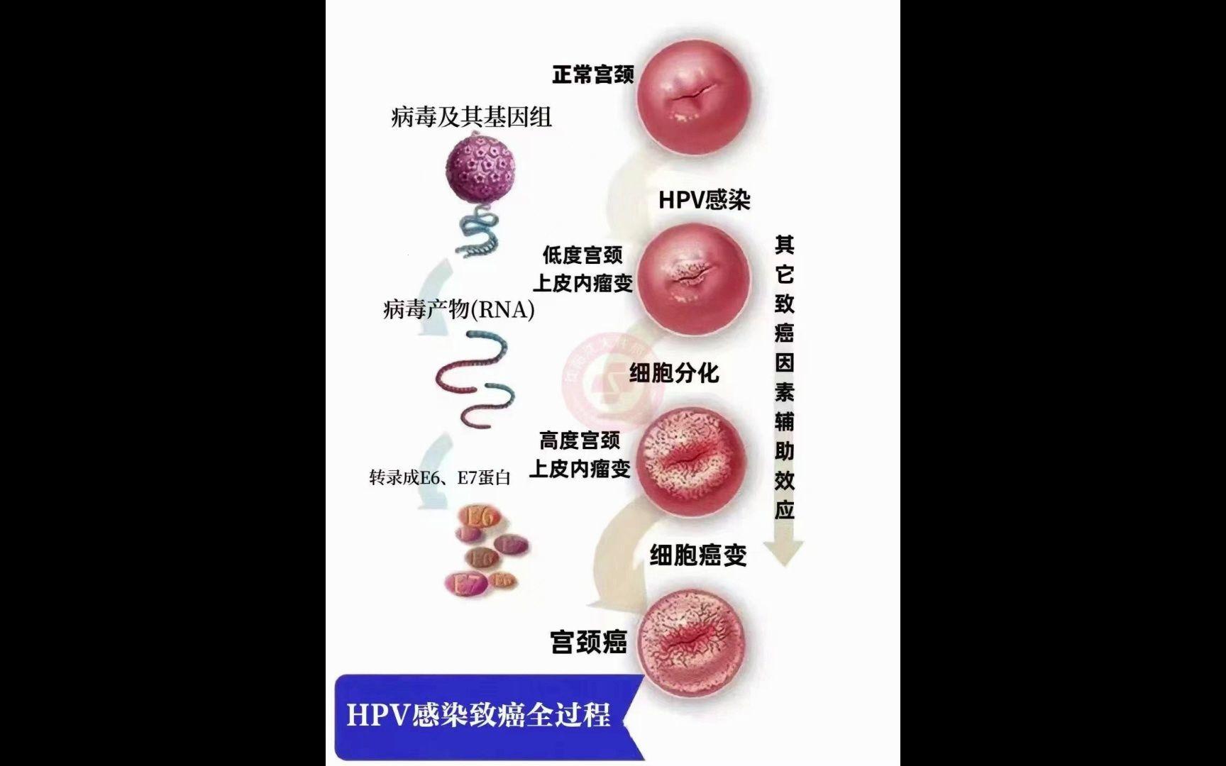 女性的HPV感染之路：笑中带泪的“奇遇”