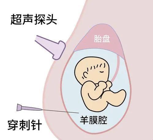 神经纤维瘤羊水穿刺，我这是要变超级英雄了吗？