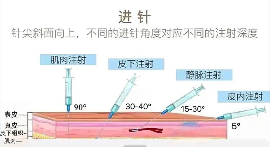 针尖上的舞蹈：注射法的角度与部位，笑谈间见真章