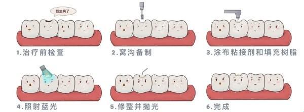 “乳牙修补大作战”：笑谈萌娃齿间风云