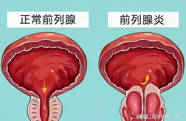 “肾”里话：前列腺增生与结石的“哥俩好”