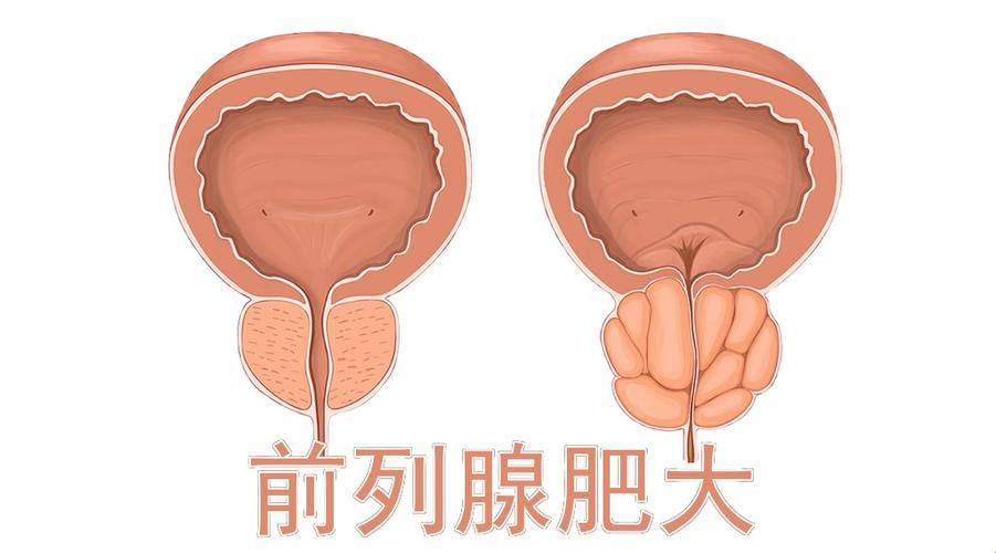 前列腺53x42x39，这规模可还行？