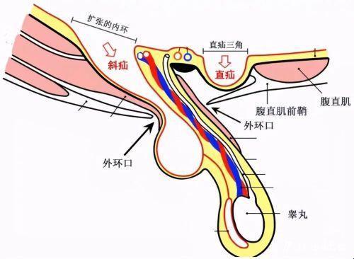 《解剖学“腹股沟”：斜疝与直疝，谁主“凸”动？》