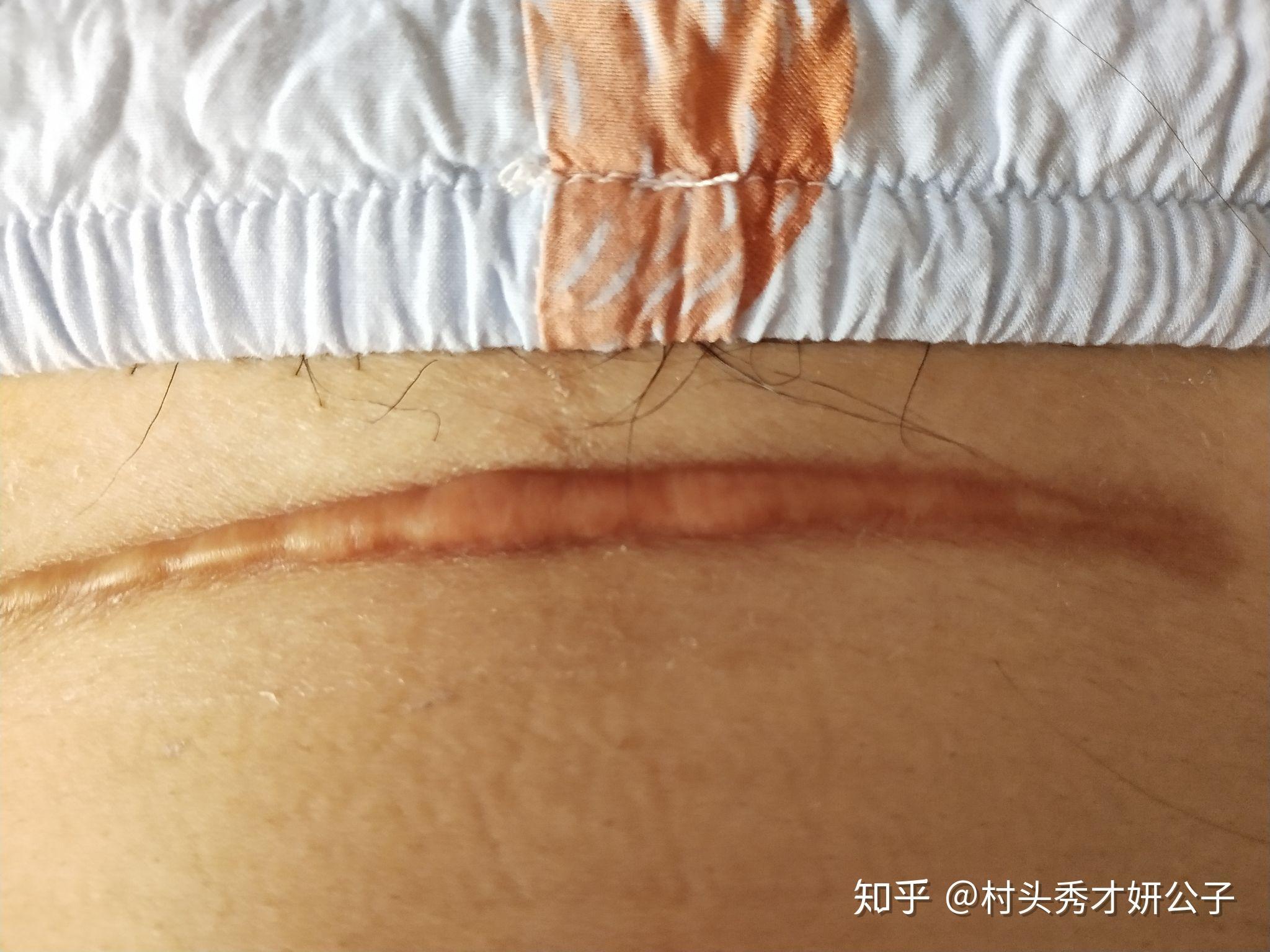 三胎挑战：剖腹产疤痕增生，咱们聊点实际的