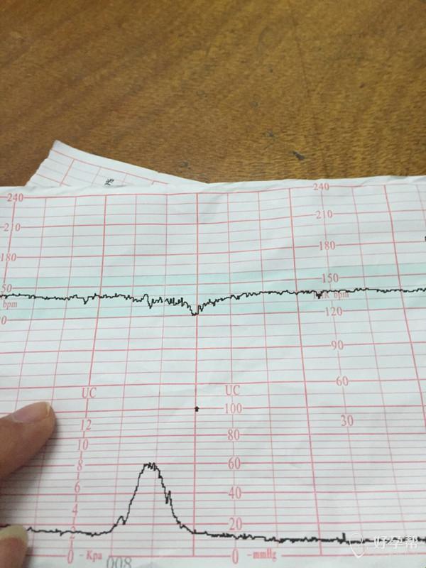 胎心监护“闯关节”，宝宝心跳成“谜语”