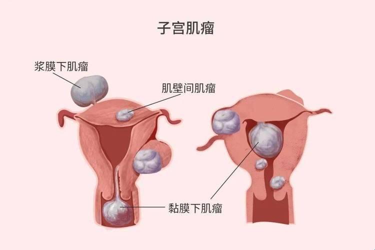 “子宫肌瘤”这块“石头”怎么就落在了你的肚子里？