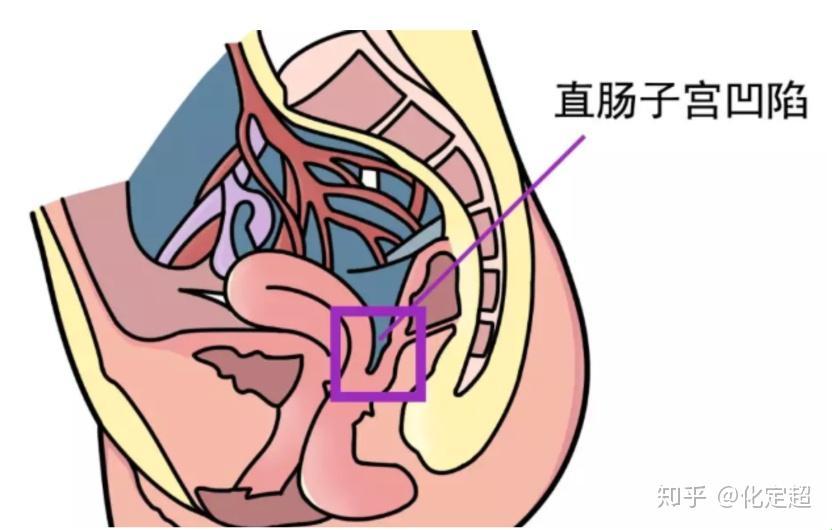 “子宫直肠窝积液”是个啥玩意儿？